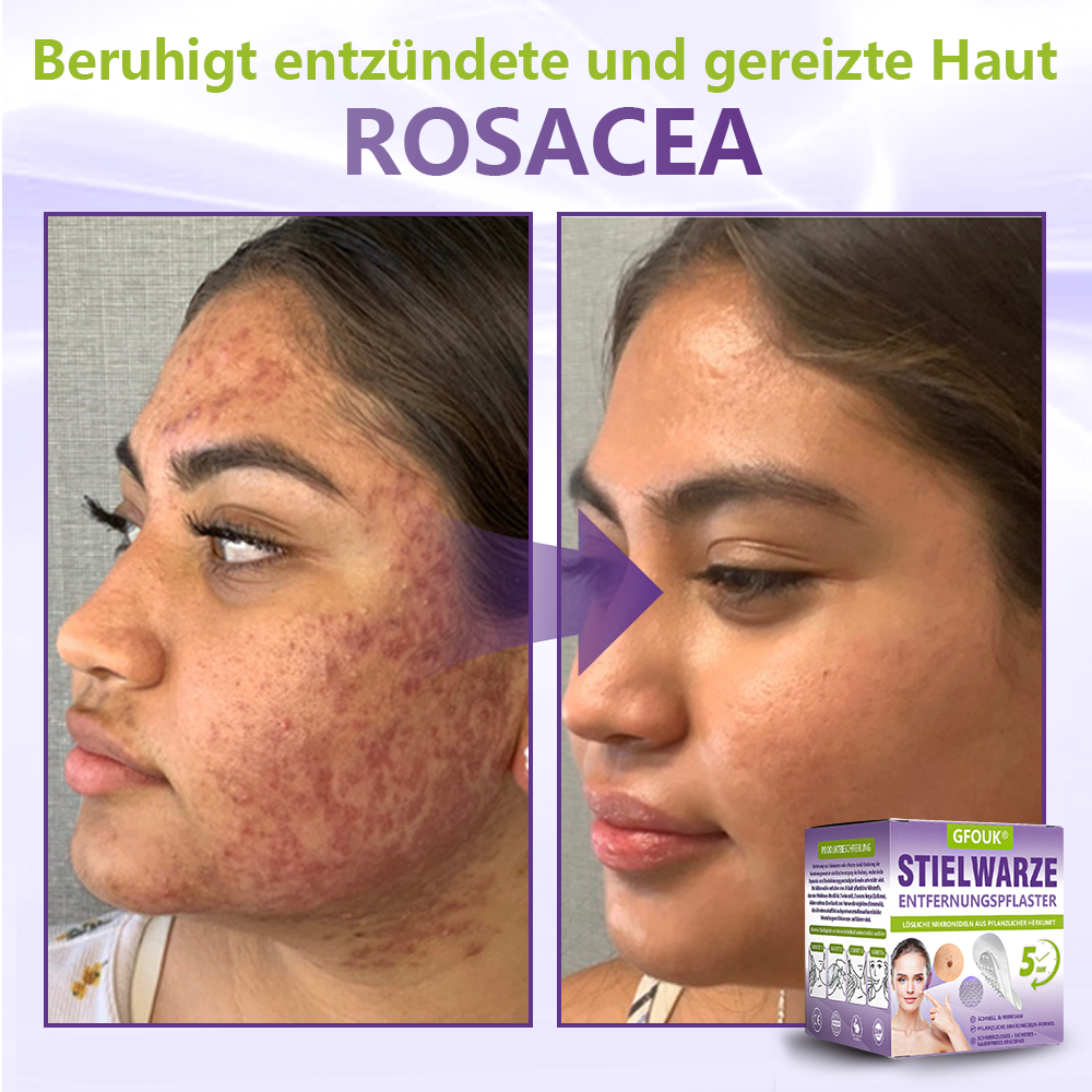 ♦️GFOUK® Lösliches Mikronadel-Pflaster zur Entfernung von Hautanhängseln auf Pflanzenbasis