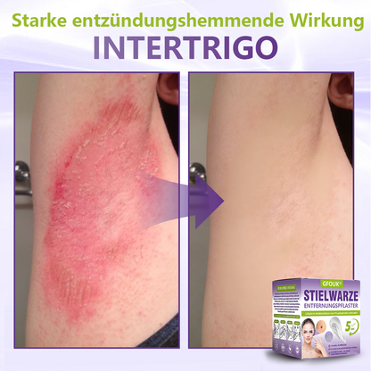 ♦️GFOUK® Lösliches Mikronadel-Pflaster zur Entfernung von Hautanhängseln auf Pflanzenbasis