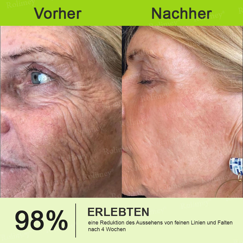 Rolimey® Botox & Vita-A Retinol Shot Falten-Lift Straffungscreme🇩🇪Jetzt jugendliche Haut zurückgewinnen