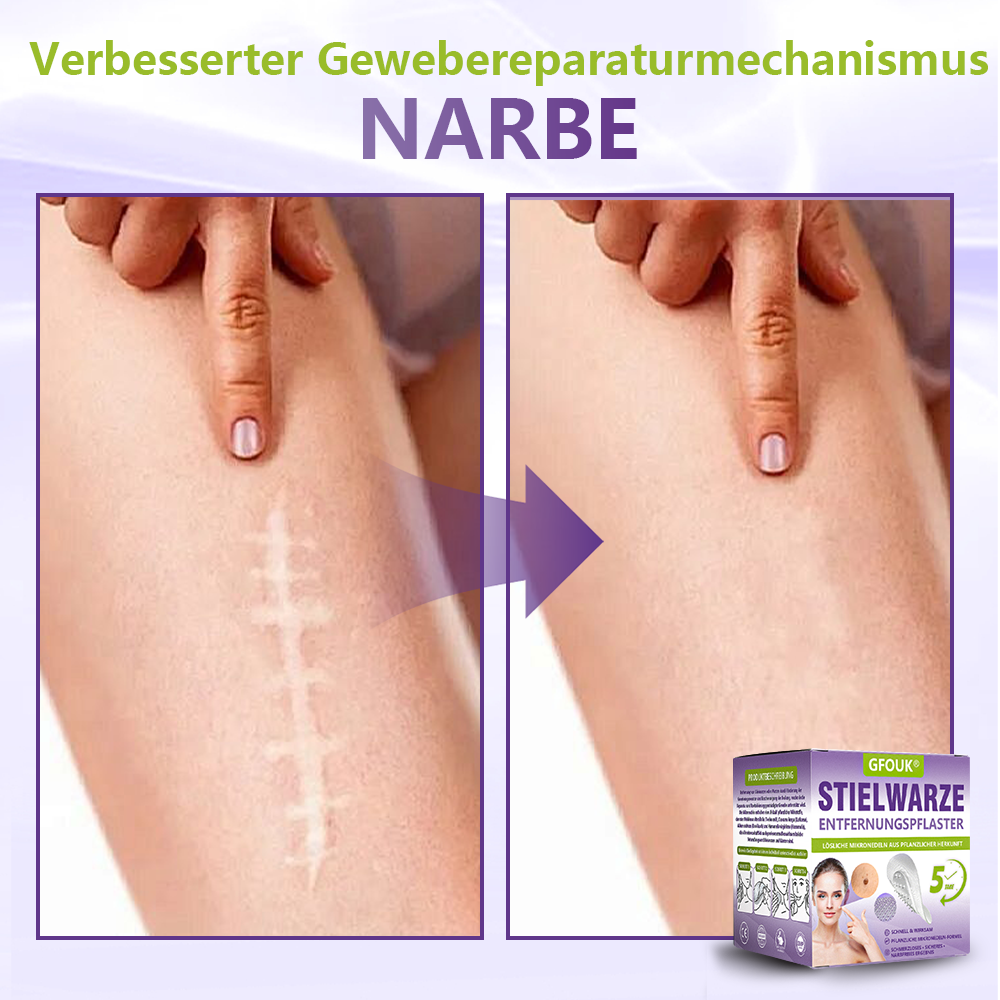 ♦️GFOUK® Lösliches Mikronadel-Pflaster zur Entfernung von Hautanhängseln auf Pflanzenbasis