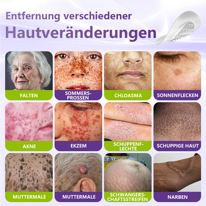♦️GFOUK® Lösliches Mikronadel-Pflaster zur Entfernung von Hautanhängseln auf Pflanzenbasis