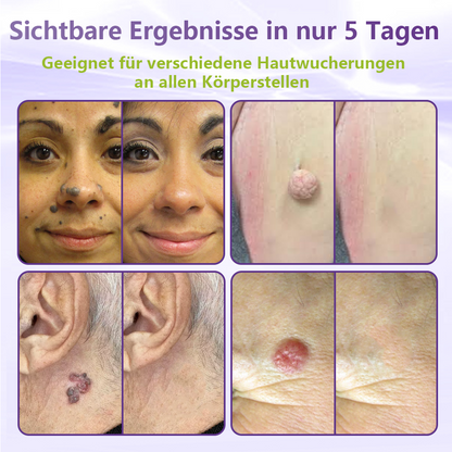♦️GFOUK® Lösliches Mikronadel-Pflaster zur Entfernung von Hautanhängseln auf Pflanzenbasis