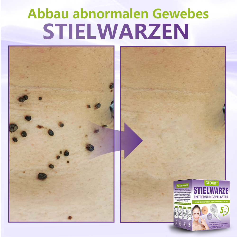 ♦️GFOUK® Lösliches Mikronadel-Pflaster zur Entfernung von Hautanhängseln auf Pflanzenbasis