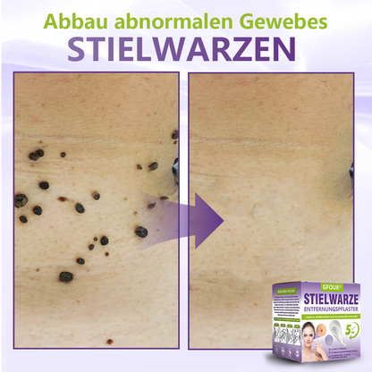 ♦️GFOUK® Lösliches Mikronadel-Pflaster zur Entfernung von Hautanhängseln auf Pflanzenbasis