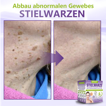 ♦️GFOUK® Lösliches Mikronadel-Pflaster zur Entfernung von Hautanhängseln auf Pflanzenbasis
