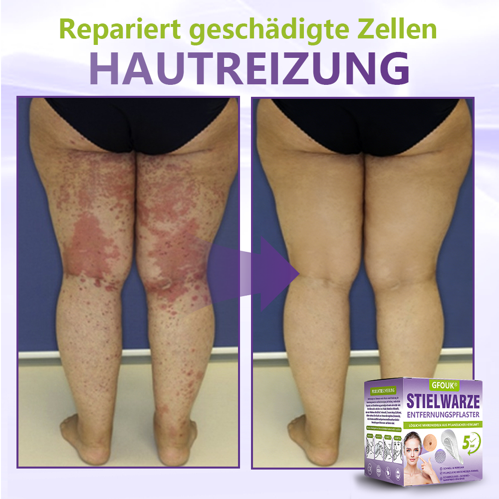 ♦️GFOUK® Lösliches Mikronadel-Pflaster zur Entfernung von Hautanhängseln auf Pflanzenbasis