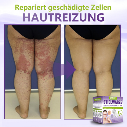 ♦️GFOUK® Lösliches Mikronadel-Pflaster zur Entfernung von Hautanhängseln auf Pflanzenbasis