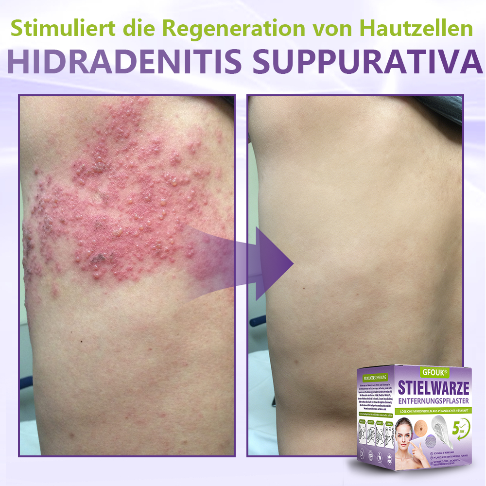 ♦️GFOUK® Lösliches Mikronadel-Pflaster zur Entfernung von Hautanhängseln auf Pflanzenbasis