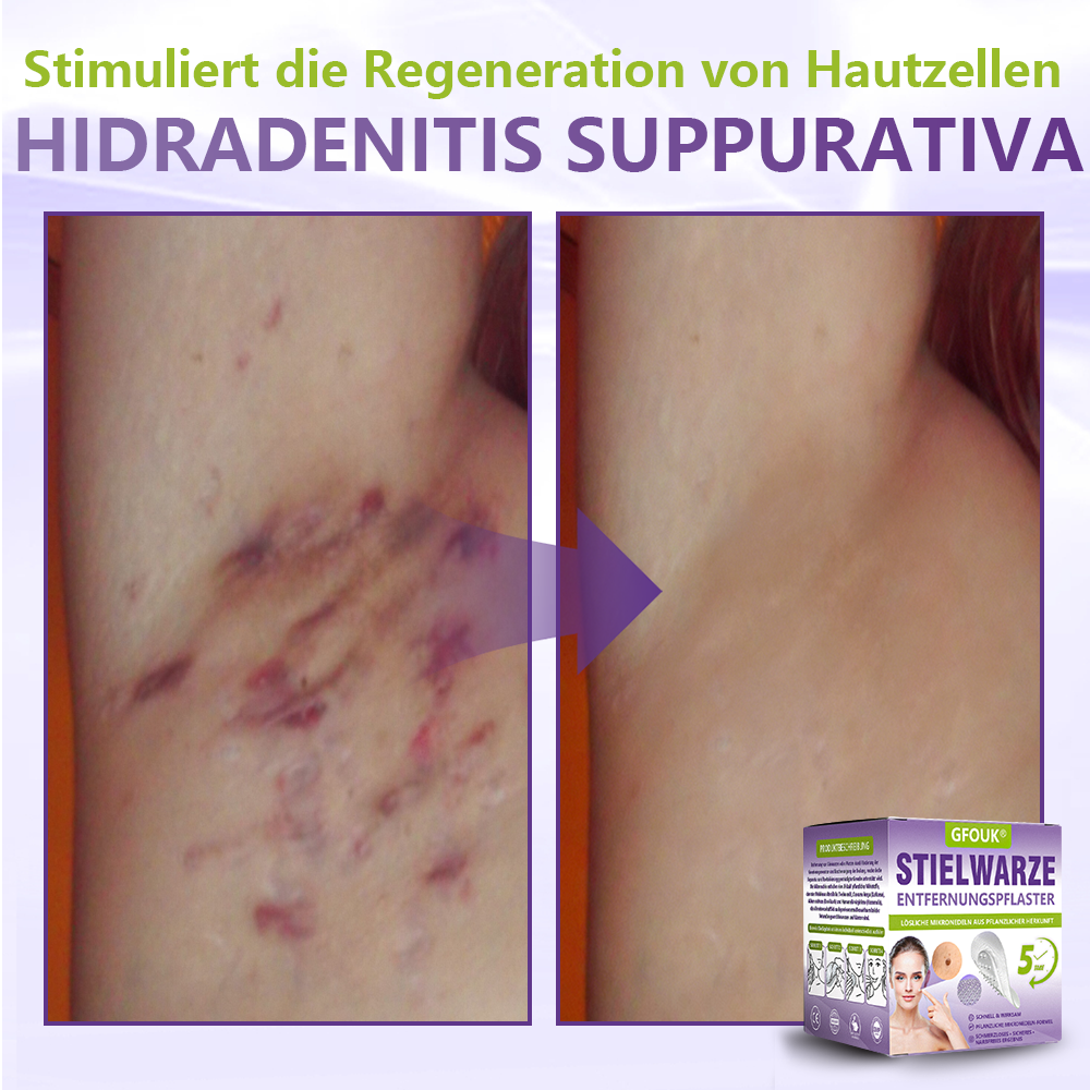 ♦️GFOUK® Lösliches Mikronadel-Pflaster zur Entfernung von Hautanhängseln auf Pflanzenbasis