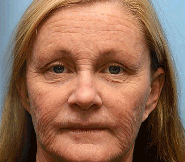 Rolimey® Botox & Vita-A Retinol Shot Falten-Lift Straffungscreme🇩🇪Jetzt jugendliche Haut zurückgewinnen