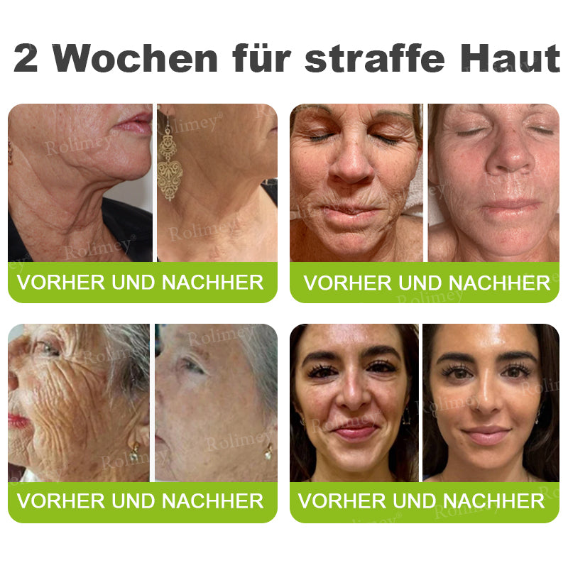 Rolimey® Botox & Vita-A Retinol Shot Falten-Lift Straffungscreme🇩🇪Jetzt jugendliche Haut zurückgewinnen