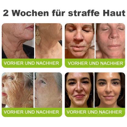 Rolimey® Botox & Vita-A Retinol Shot Falten-Lift Straffungscreme🇩🇪Jetzt jugendliche Haut zurückgewinnen